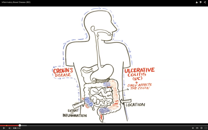 Enfermedad Inflamatoria Intestinal -Enfermedad de Crohn y Colitis Ulcerosa.