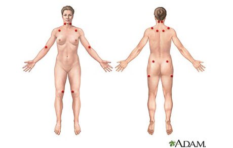 fibromialgia2